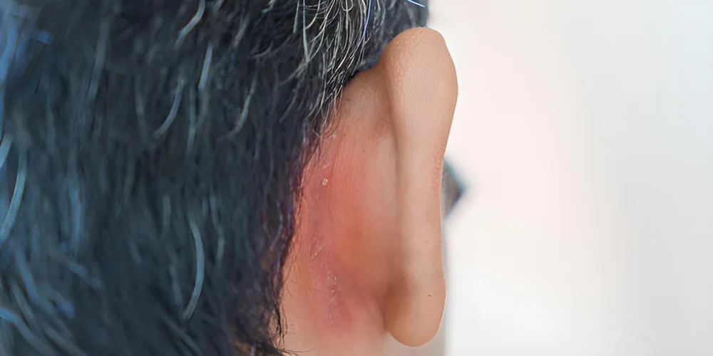 کرم حلقویی اسکالپ