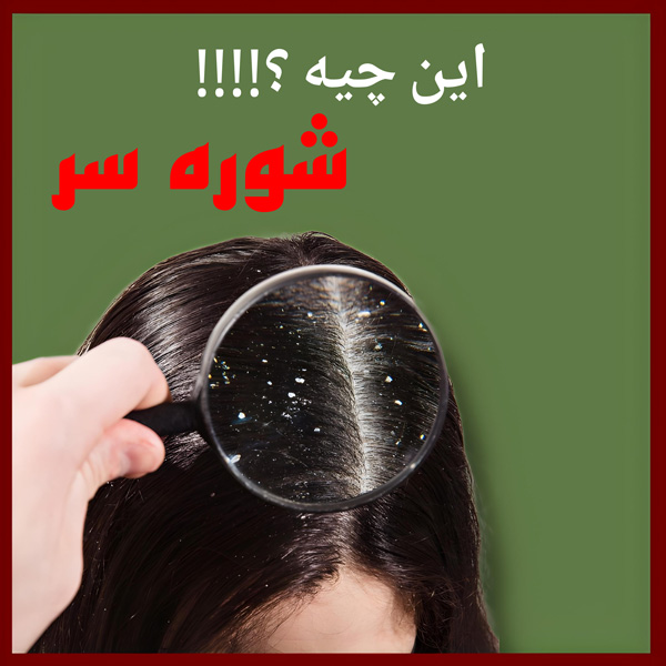 درمان شوره سر