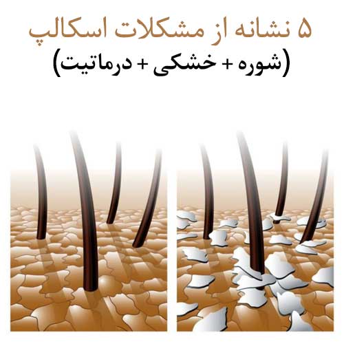 5 نشانه از مشکلات اسکالپ (شوره، خشکی، درماتیت) + راهکار درمانی