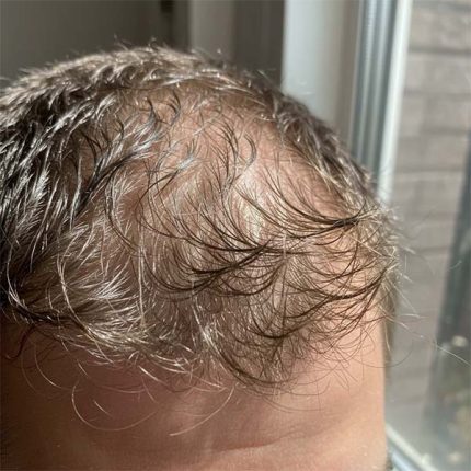 ریزش مو چرب